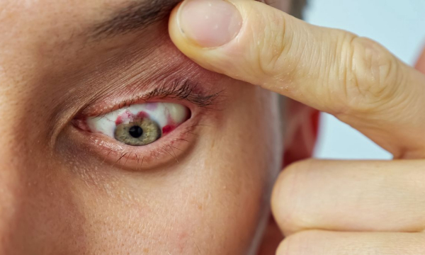 Почему лопаются сосуды в глазах